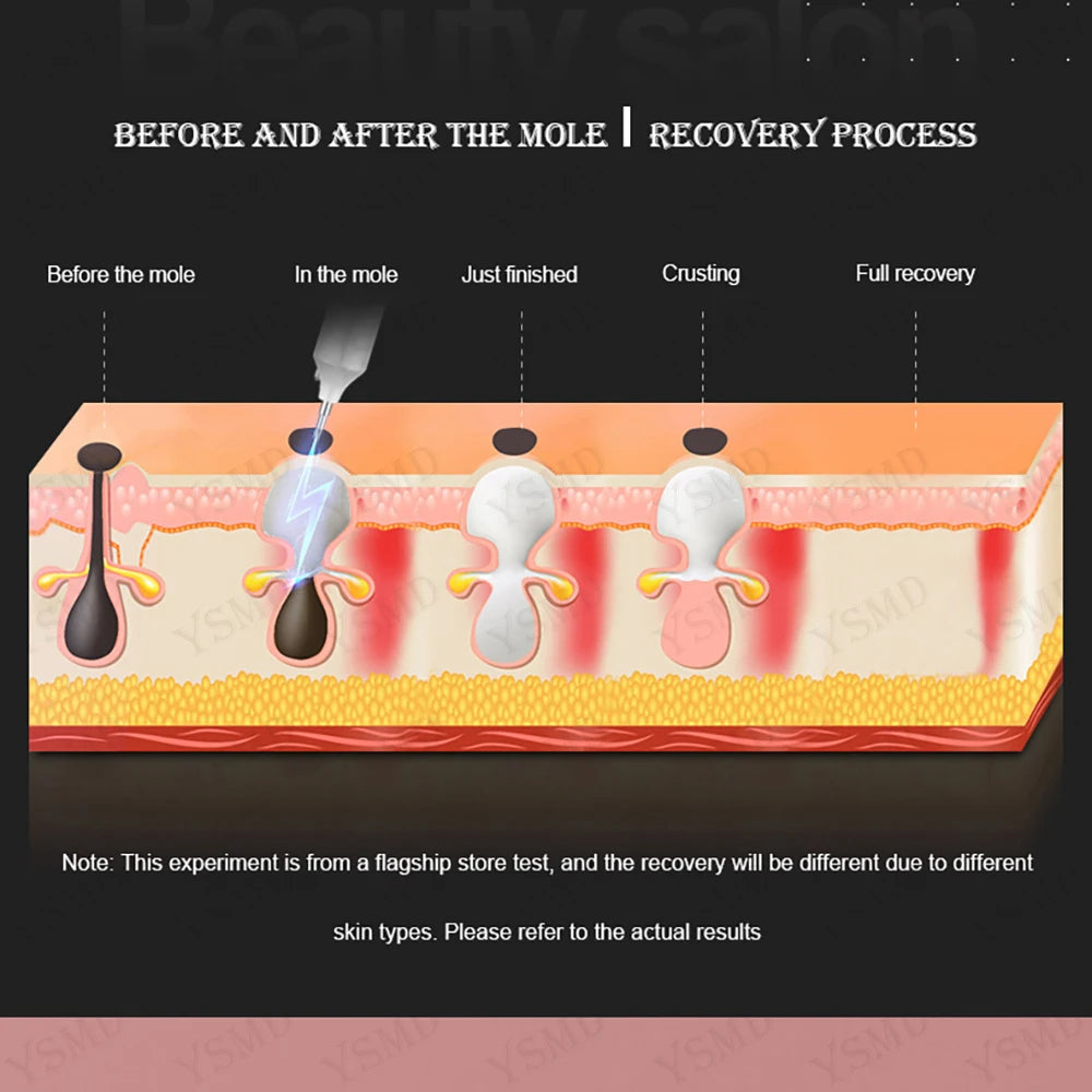 Laser SmoothSkin Pen