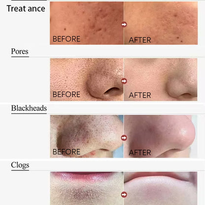 ClearSkin Pore Cleanser